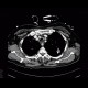 Postspecific changes in lung: CT - Computed tomography